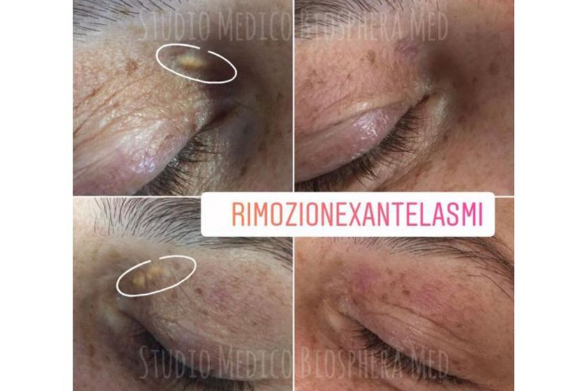 Xantelasmi prima e dopo - 789361