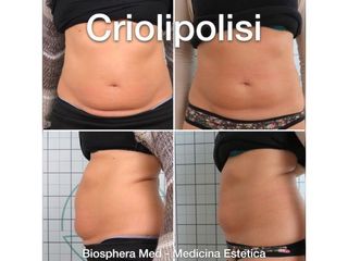Criolipolisi - Studio medico BiospheraMed