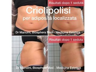 Criolipolisi - Studio medico BiospheraMed