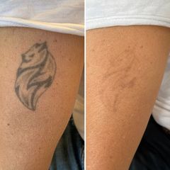 Rimozione Tatuaggio BiospheraMed