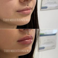 Lipfiller - Biosphera Med