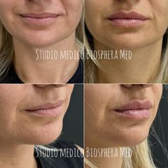 Lipfiller - Biosphera Med