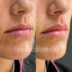 Biosphera Med Filler labbra