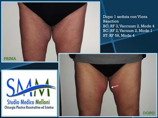 Body contouring prima dopo
