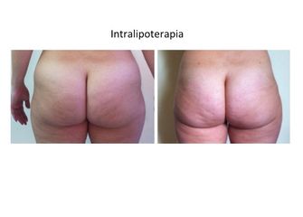 Laserlipolisi e mesoterapia + cavitazione