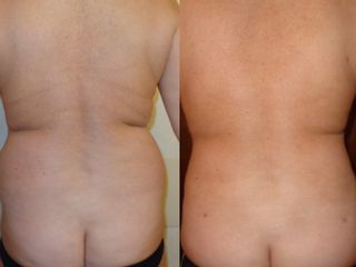 Lipo prima e dopo