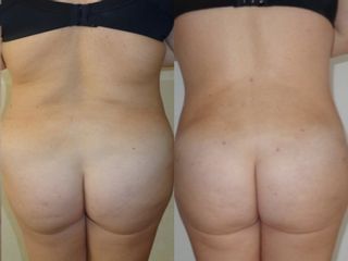 Liposuzione prima e dopo