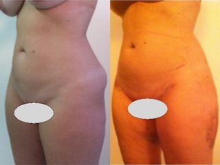 Liposuzione prima e dopo