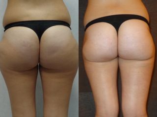 Liposuzione prima e dopo
