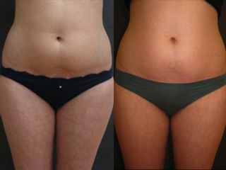 Liposcultura prima e dopo