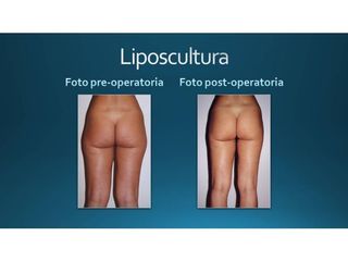 Liposcultura prima e dopo