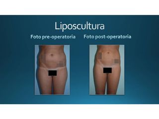 Liposcultura prima e dopo