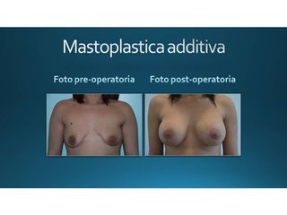Mastoplastica additiva prima e dopo