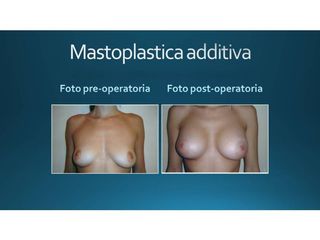 Mastoplastica additiva prima e dopo