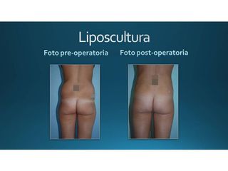 Liposcultura prima e dopo