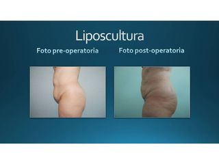 Liposcultura prima e dopo