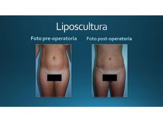 Liposcultura prima e dopo