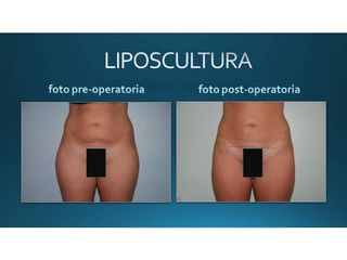 Liposcultura prima e dopo