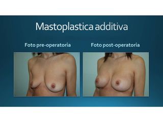 Mastoplastica additiva prima e dopo