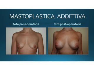 Mastoplastica additiva prima e dopo