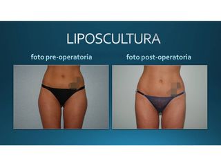 Liposcultura prima e dopo
