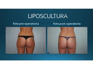 Liposcultura prima e dopo