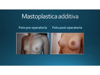 Mastoplastica additiva prima e dopo