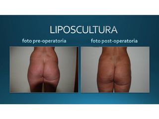 Liposcultura prima e dopo