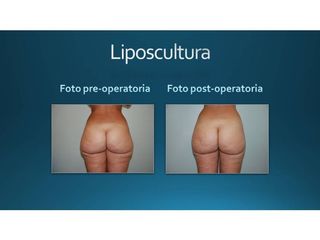 Liposcultura prima e dopo