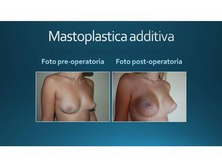 Mastoplastica additiva prima e dopo