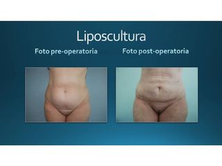 Liposcultura prima e dopo