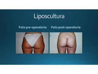 Liposcultura prima e dopo