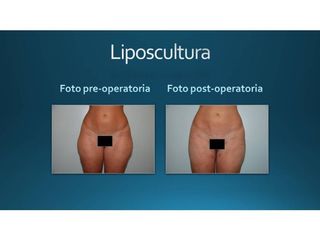 Liposcultura prima e dopo