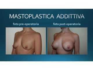 Mastoplastica additiva prima e dopo