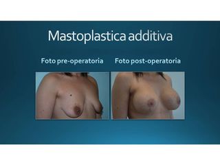 Mastoplastica additiva prima e dopo