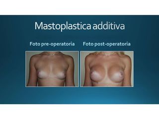 Mastoplastica additiva prima e dopo