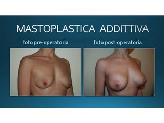Mastoplastica additiva prima e dopo
