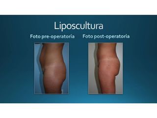 Liposcultura prima e dopo