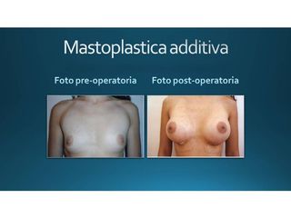Mastoplastica additiva prima e dopo