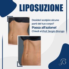 Liposuzione  - Prof. Sergio Brongo