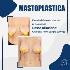 Mastoplastica additiva - Prof. Sergio Brongo