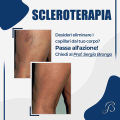 Scleroterapia - Prof. Sergio Brongo