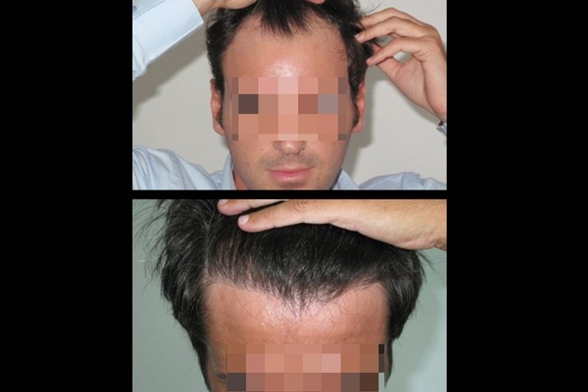 Trapianto capelli prima e dopo - 761050