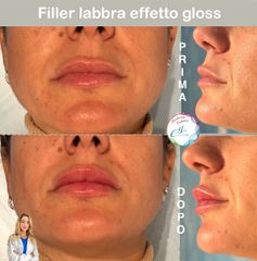 Dott.ssa Iole Cucinotto Filler labbra