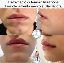 Dott.ssa Iole Cucinotto Femminilizzazione del volto maschile (transizione di genere)