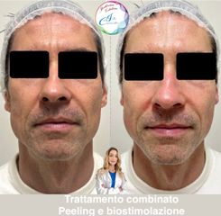 Dott.ssa Iole Cucinotto Combo peeling e Biorivitalizzazione con acido ialuronico