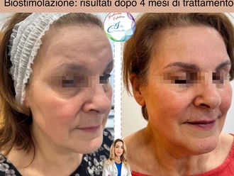 Acido ialuronico prima e dopo - 876561