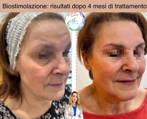 Dott.ssa Iole Cucinotto Biorivitalizzazione con acido ialuronico