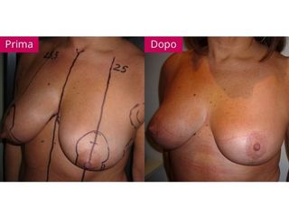Mastopessi prima e dopo