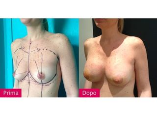 Mastopessi prima e dopo